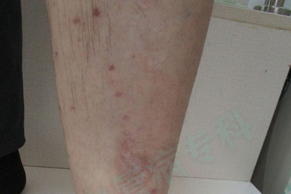 静脉曲张的主要症状是什么？齐齐哈尔下肢静脉曲张的识别！