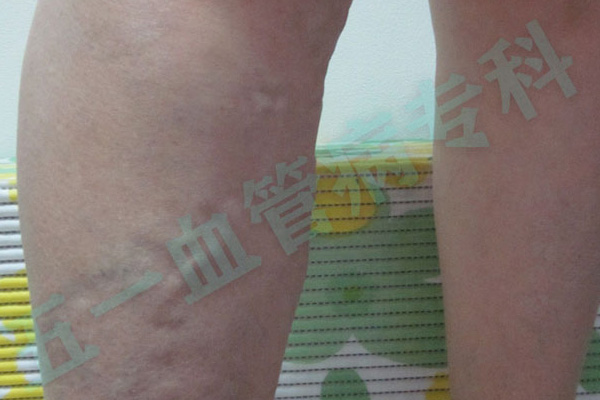 静脉曲张有哪些类型？吉林市静脉曲张专科帮你了解病情严重程度！