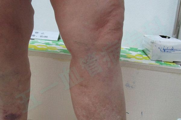 什么是静脉曲张？腿上血管扭曲如蚯蚓爬，哈尔滨静脉曲张专科医院普及静脉曲张知识！