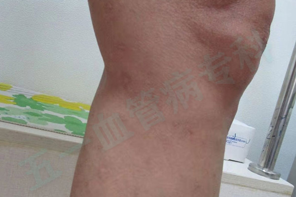 告别开刀切口，免抽血管创伤小，静脉曲张微创手术全过程详解！