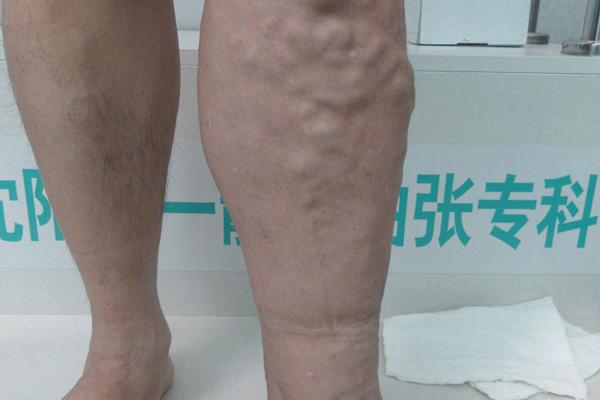静脉曲张和血管炎怎么分辨？抚顺静脉曲张恢复锻炼方法!