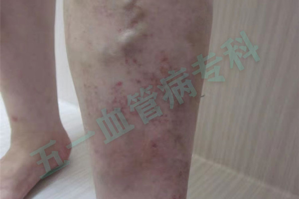 静脉曲张会影响哪些部位？大连静脉曲张和大连深静脉血栓的治疗区别