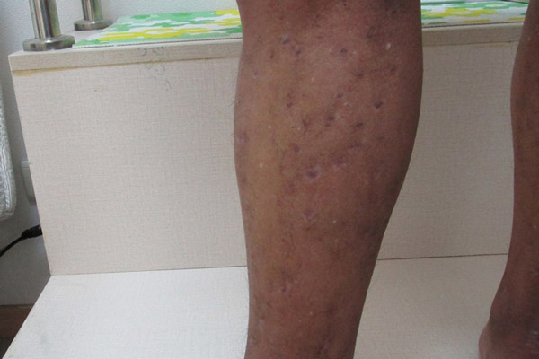 静脉曲张与血管收缩的区别，静脉曲张沈阳哪个医院治得好！