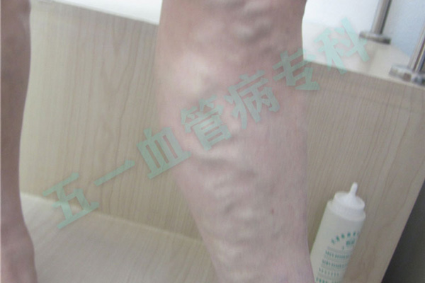 下肢静脉曲张和动脉瘤有什么区别？鞍山静脉曲张较快消除方法!