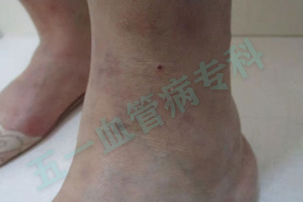 静脉曲张和血管损伤有什么区别？辽宁静脉曲张专科医院对这两种疾病进行病理的介绍和比较！