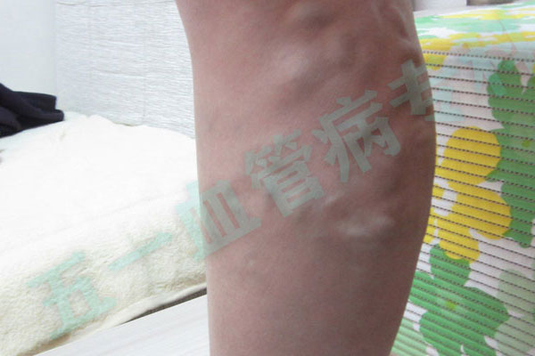 下肢静脉曲张：沈阳静脉曲张专科医院五一静脉曲张专科及时治疗，拒绝等待自愈！