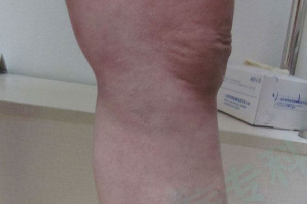 大连静脉曲张专科医院五一静脉曲张专科治疗静脉曲张血栓