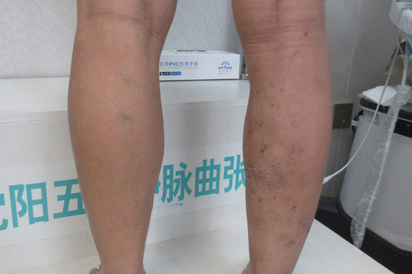 静脉曲张与血管破裂的区别，大连静脉曲张手术哪家医院好帮助患者更好地理解它们！