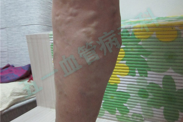 血管扩张会导致静脉曲张吗？辽阳静脉曲张专科告诉你什么是毛细血管扩张？