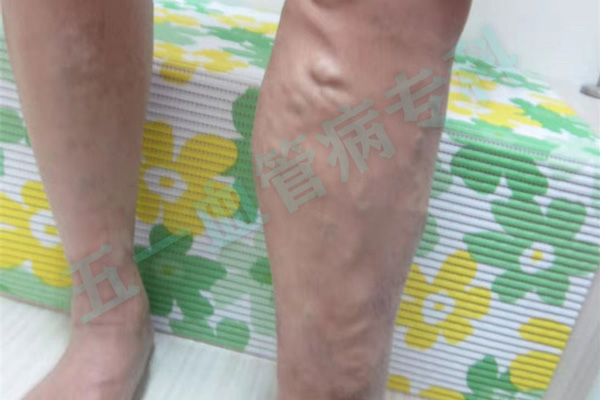 静脉曲张压力袜和淋巴水肿压力袜有什么不同?丹东静脉曲张和淋巴水肿怎么治疗