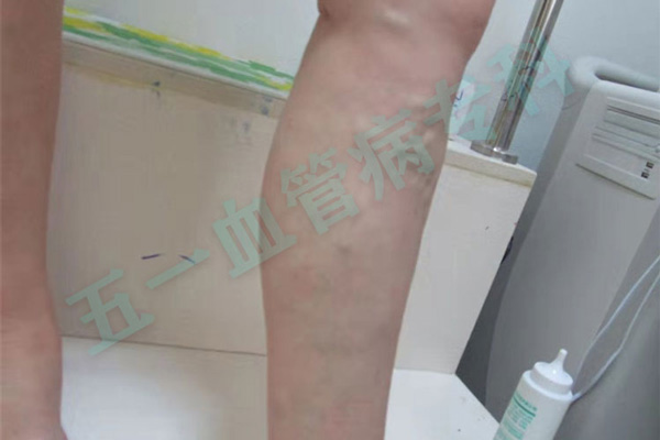 静脉曲张和血管阻塞有什么区别？辽宁血管病医院告诉你如何预防血管阻塞？