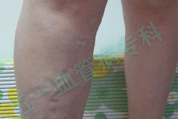 大连静脉曲张专科医院科普：静脉系统的正常结构及静脉曲张病症会带来哪些变化？