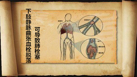 下肢静脉曲张与肺动脉栓塞